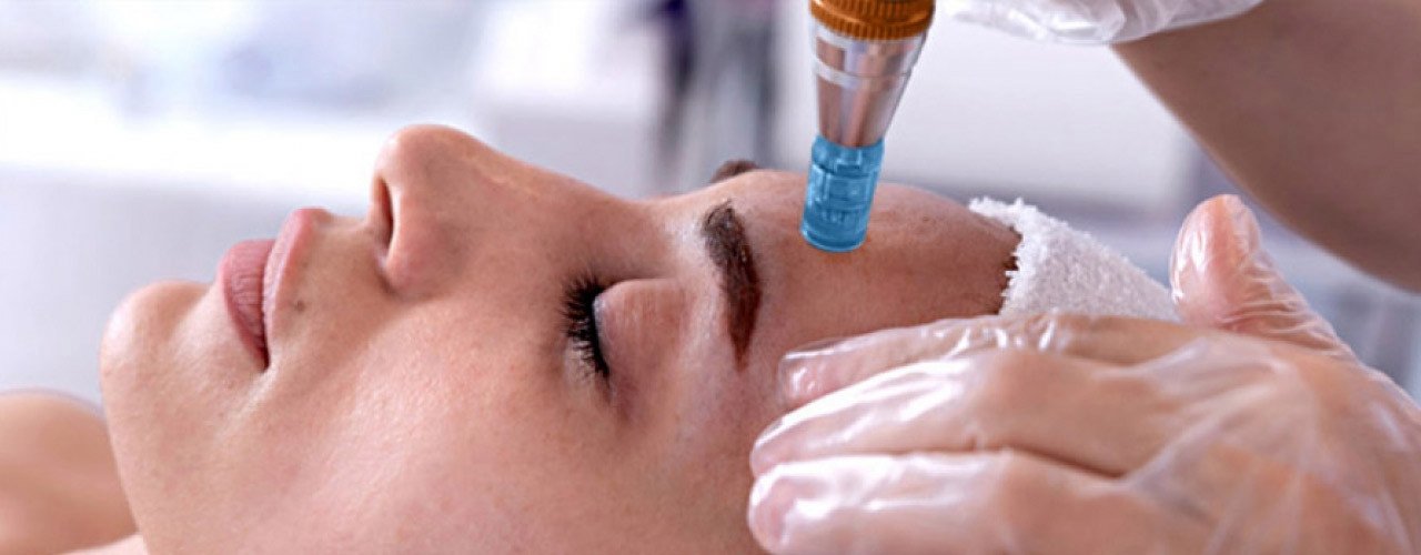 Microneedling Behandlung bei Visage Cosmetic