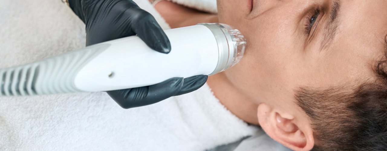 Microneedling RF: moderne Hautbildverfeinerung