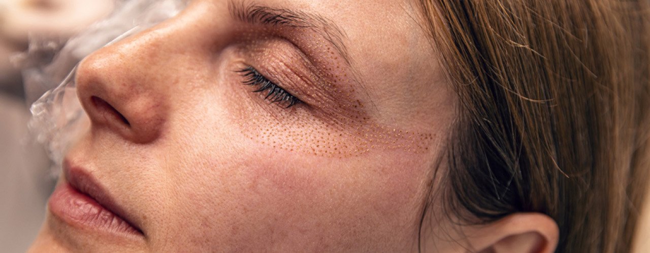 Plasma Skin: Risiken und Nebenwirkungen realistisch einschätzen