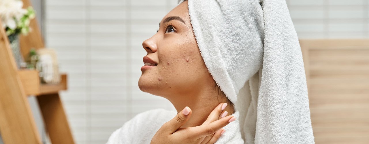 Akne und Aknenarben: Carbon Peel als Beauty-Thema