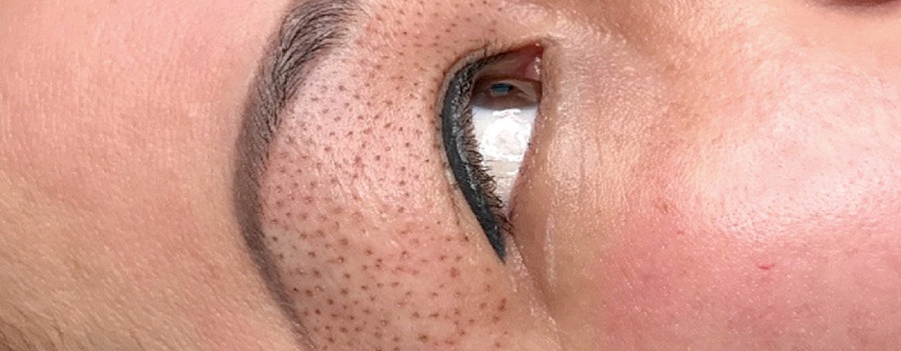 Plasma Skin Technologie